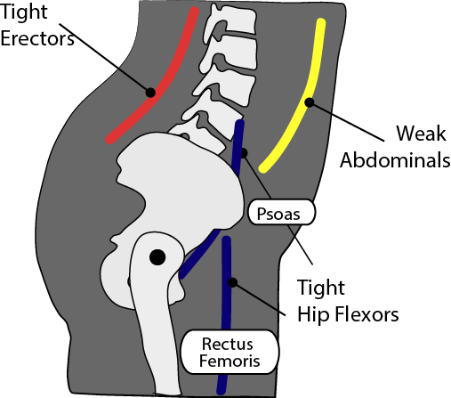 Illustration of anatomical factors causing pelvic rotation